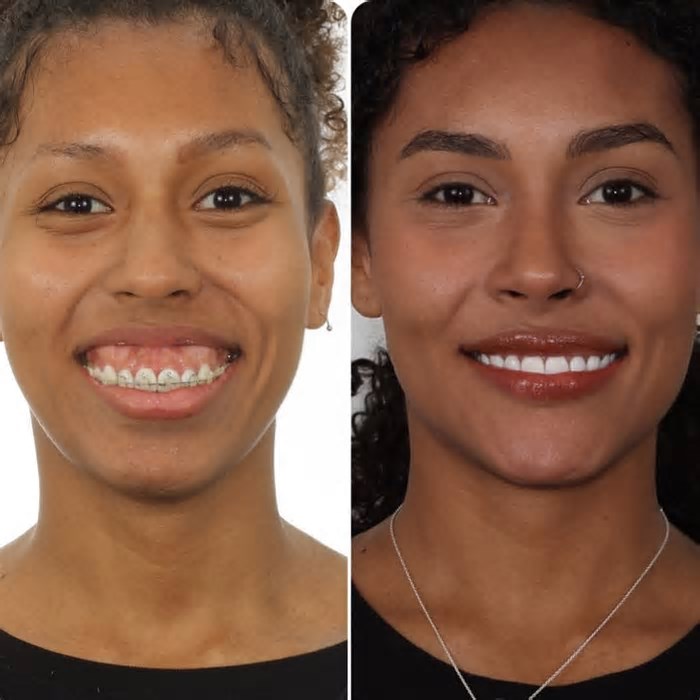 O antes e depois dos participantes do 'BBB 25': quais procedimentos estéticos eles já fizeram? Veja fotos e detalhes