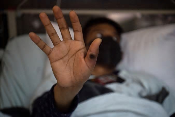 São Paulo registra primeiro caso de nova cepa de mpox no Brasil