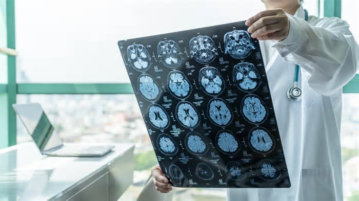 Ciência descobre que os traços de personalidade podem influenciar o risco de você ter demência no futuro