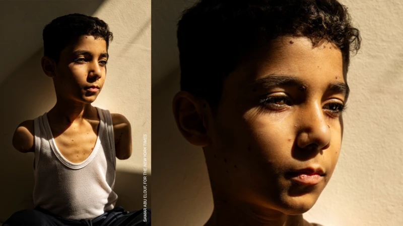 A história da chocante 'foto do ano' de menino palestino mutilado