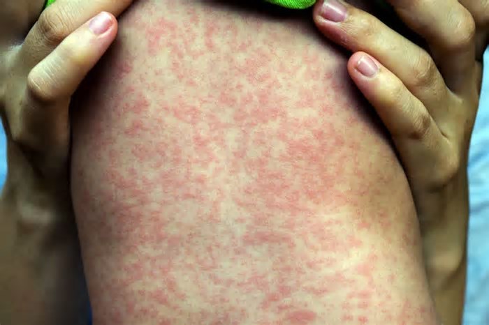 Governo vê casos isolados de sarampo, mas reforça vacina no Rio