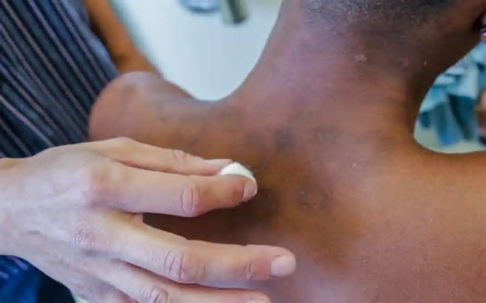 IA criada por brasileiros avalia risco de agravamento da hanseníase