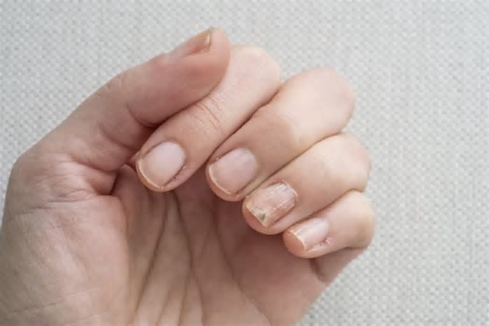 Conheça 4 alterações nas unhas que podem indicar problemas de saúde