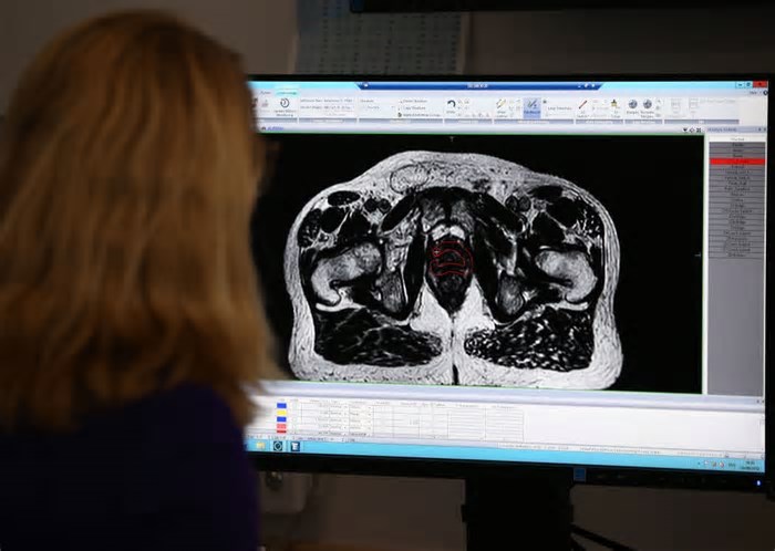 Novo teste de IA pode prever quais homens se beneficarão de medicamento contra o câncer de próstata
