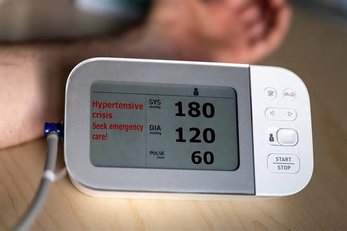 AVC, principal causa de morte cardíaca no Brasil, tem deficiência em prevenção e em atendimento rápido no SUS