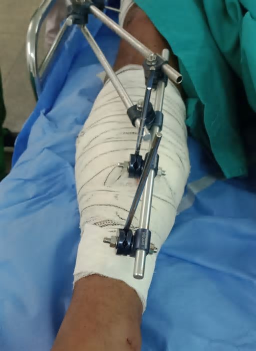 Ambulante baleado por delegado em Fernando de Noronha passa por cirurgia no Recife