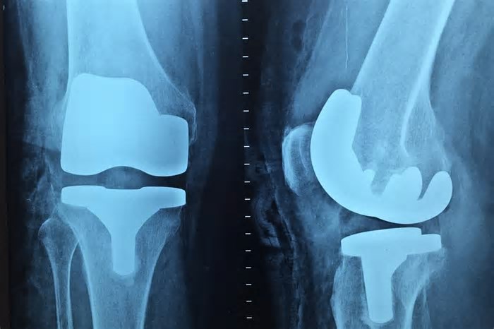 Criança com paralisia tem fratura durante fisioterapia e será indenizada por plano de saúde em BH