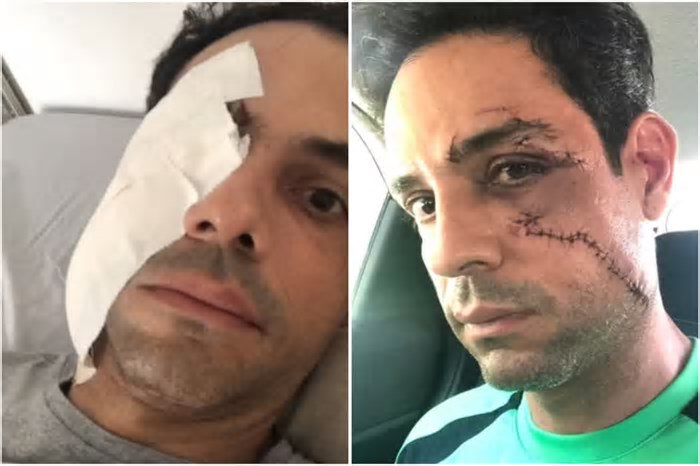 Empresário é agredido com copo de vidro e leva 62 pontos no rosto