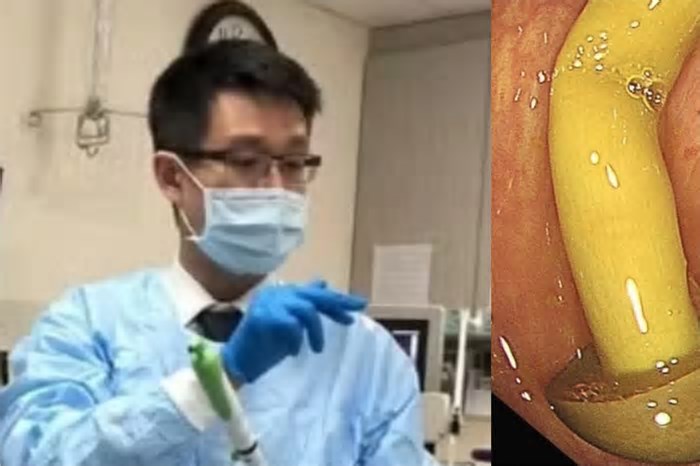 Incrível! Durante exame, médico percebe que cogumelo cresceu dentro do intestino de um homem
