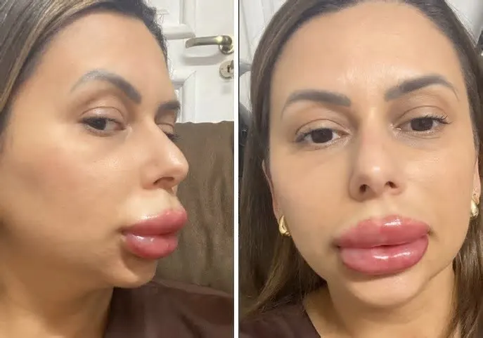 Confeiteira de Florianópolis (SC), ela já havia feito preenchimento labial quatro vezes sem intercorrências, mas, na quinta ...